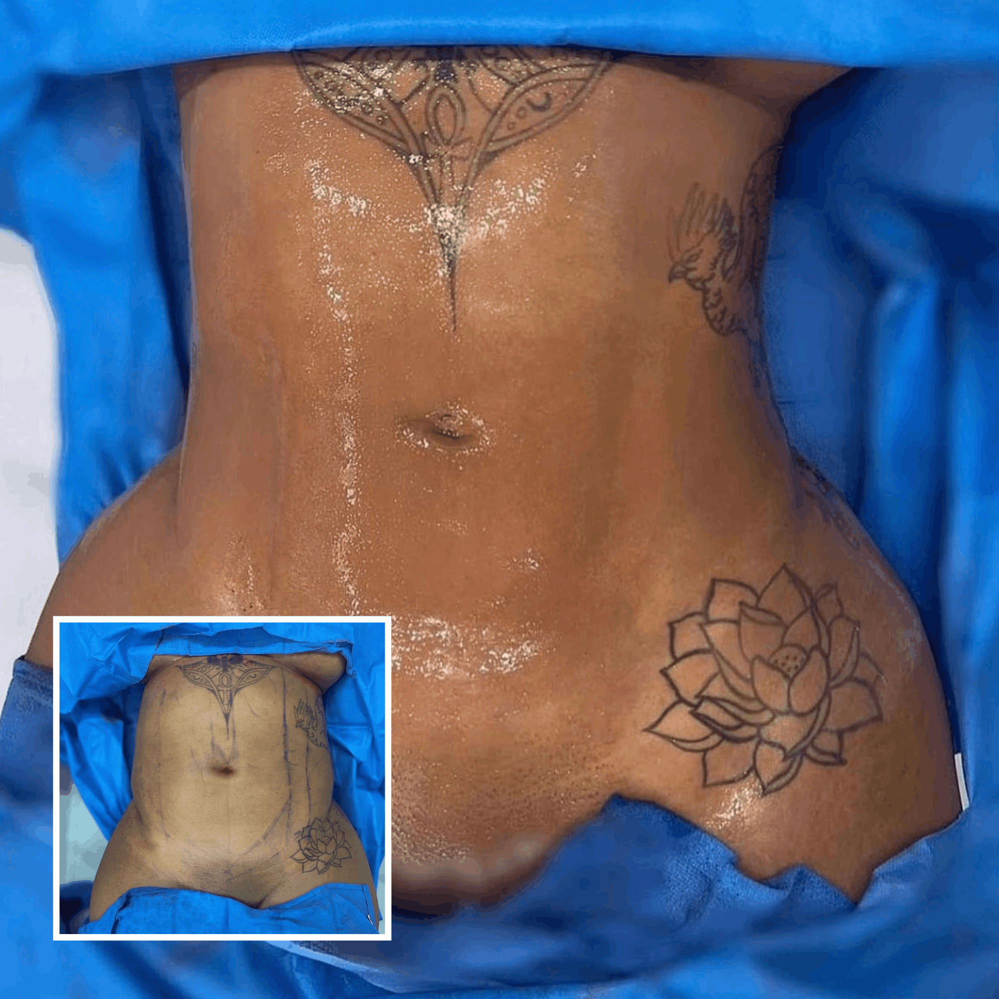 liposuction (1)